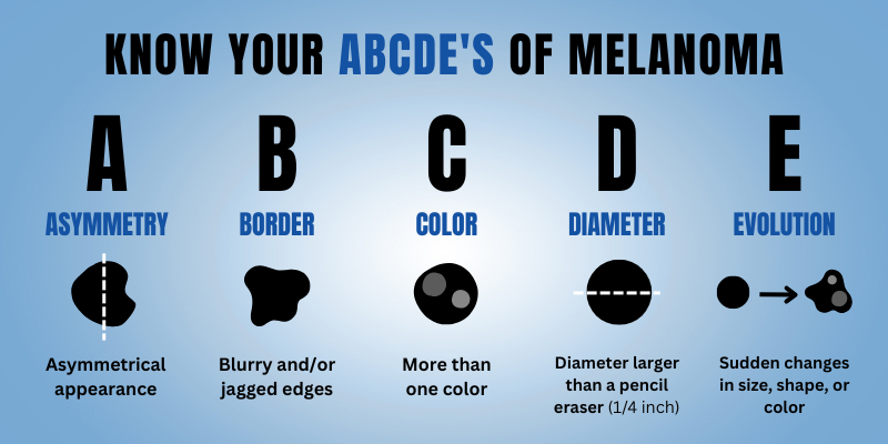Know Your ABCDE's of Melanoma