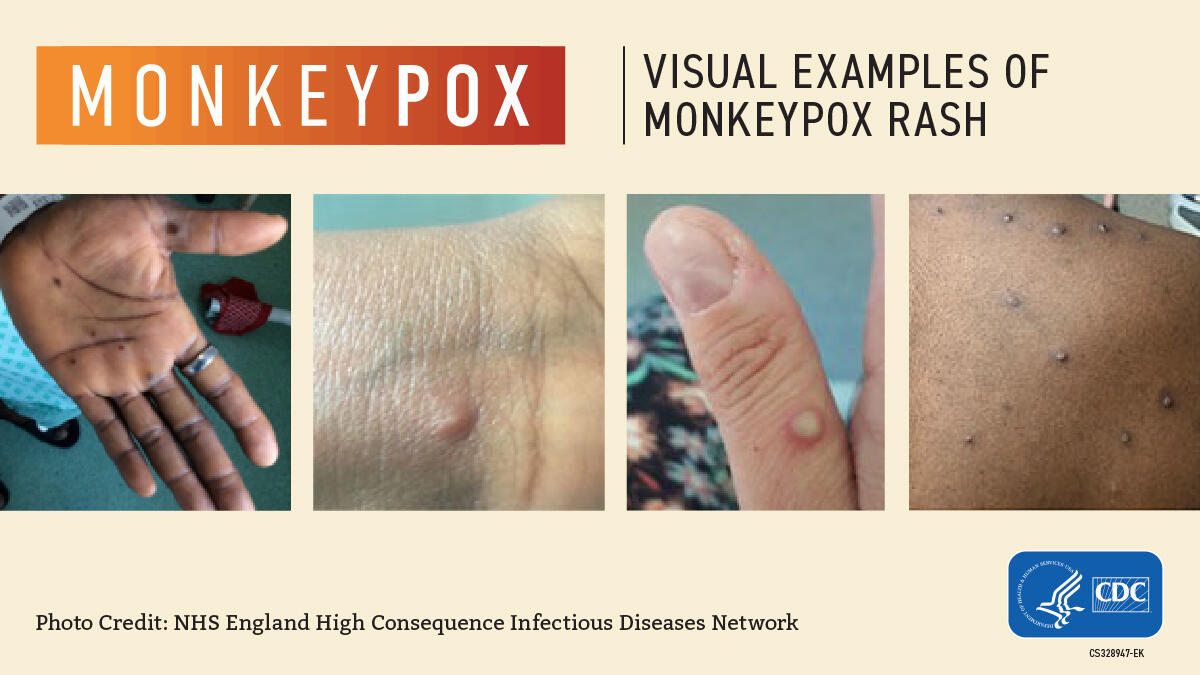 images of monkeypox rashes
